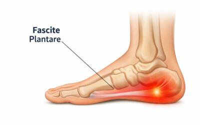 Fascite plantare: come i plantari ortopedici possono aiutare a ridurre il dolore